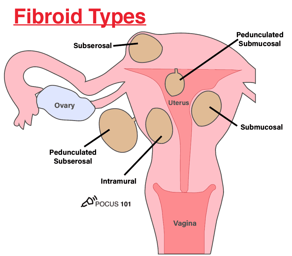 Gynecology Pelvic Ultrasound Made Easy Step By Step Guide POCUS 101 Gynecology Pelvic Ultrasound Made Easy Step By Step Guide POCUS 101